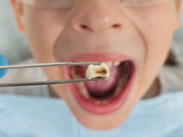 Best Emergency Wisdom Teeth Removal in Carrollton, AL